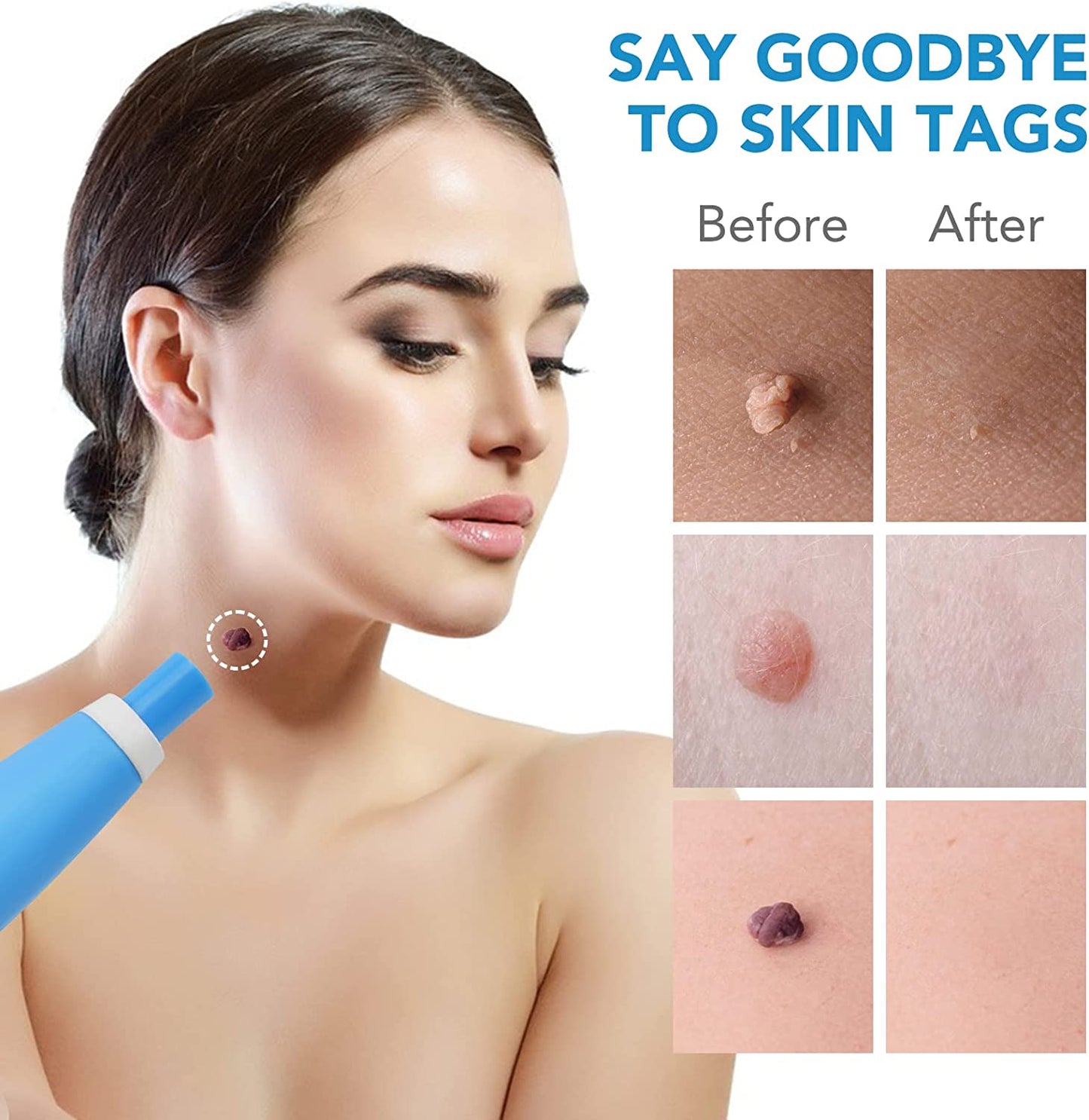 Aliver  2 in 1 Painless Skin Tag Remover Pen