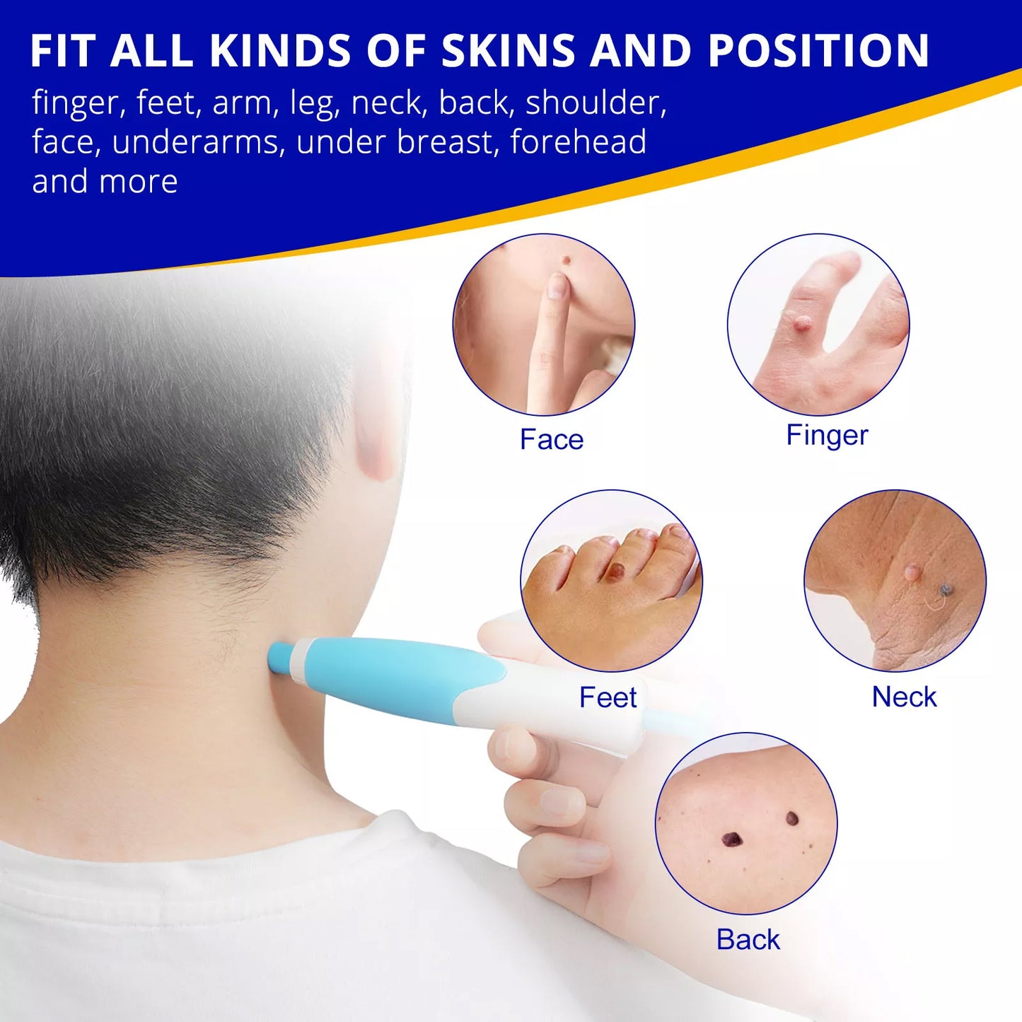 Aliver  2 in 1 Painless Skin Tag Remover Pen