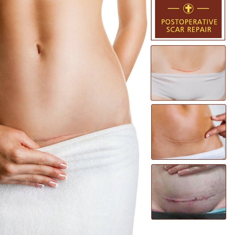 Acne Treatment And Scar Removal Cream