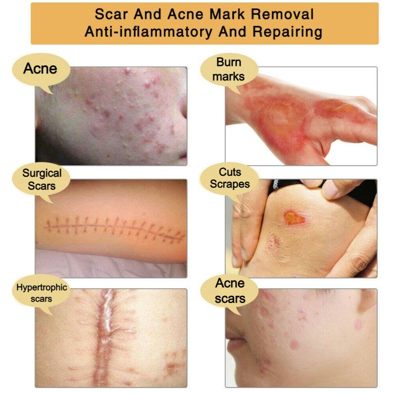 Acne Treatment And Scar Removal Cream